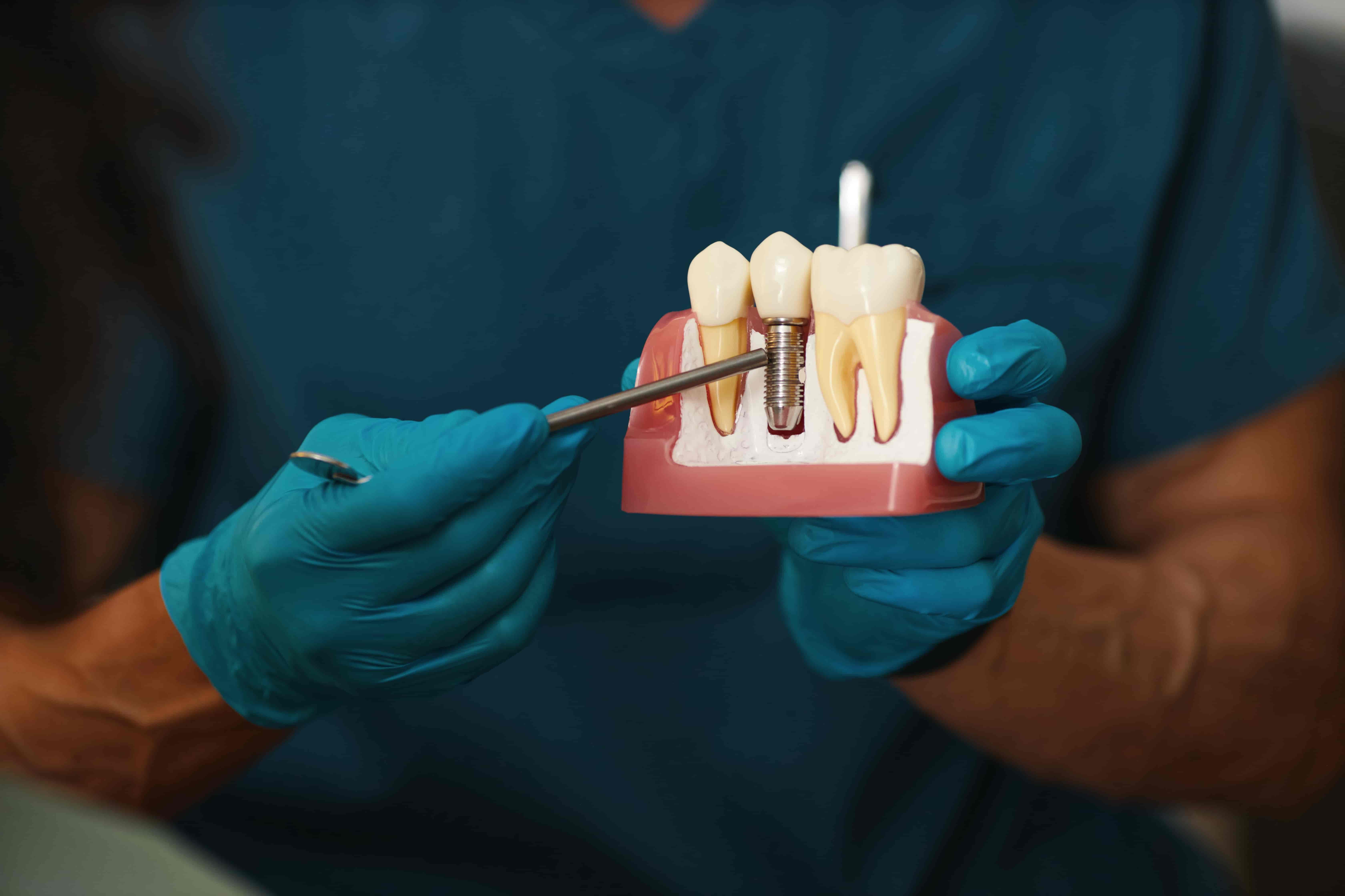 Dental Implants vs. Bridges: Which Is Better for You?